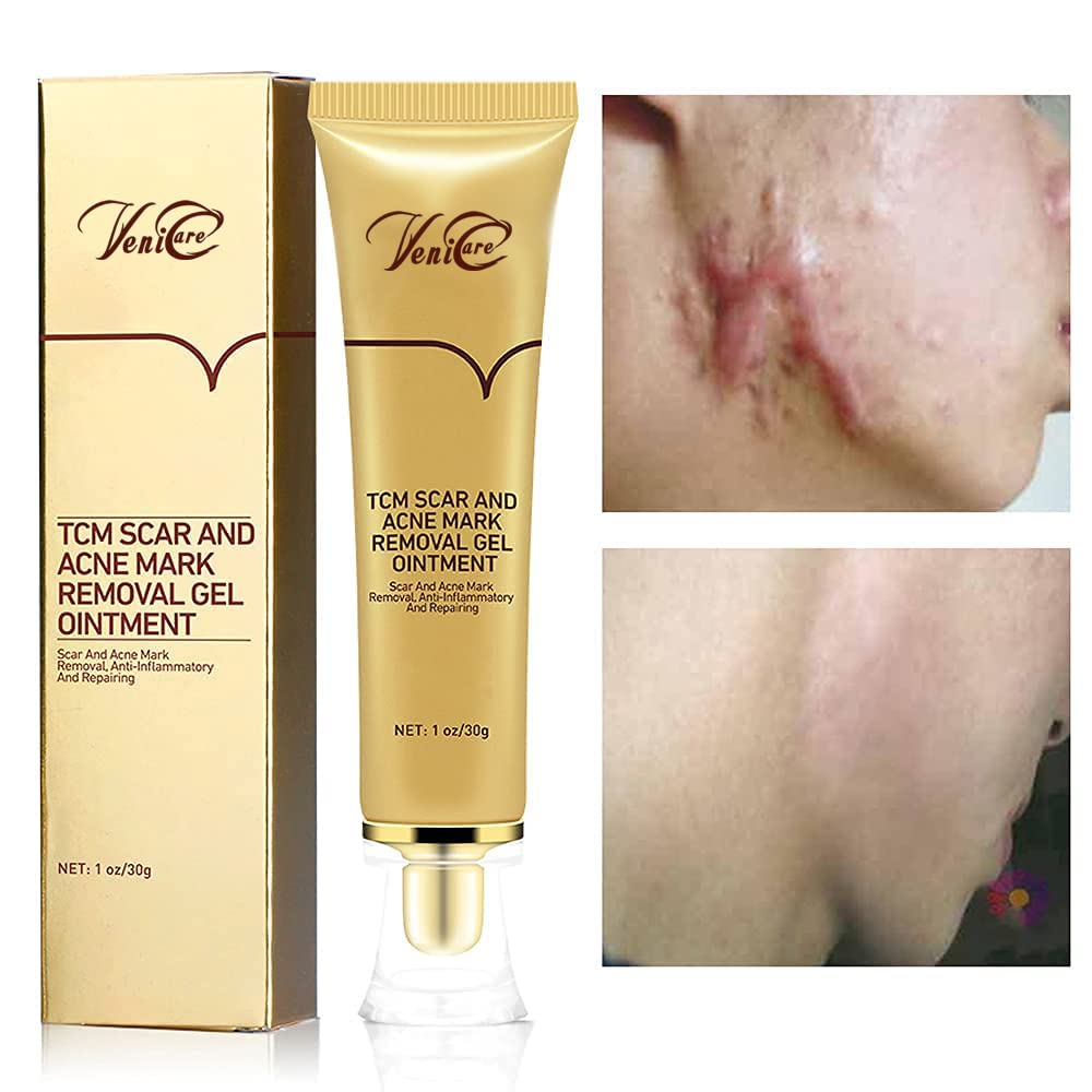 Acne Scar Removal Cream Stretch Marks Face Skin Cream Shrink Pores Gel-Fade Scar Marks Acne Skin Care (Packaging Upgrade) VeniCare