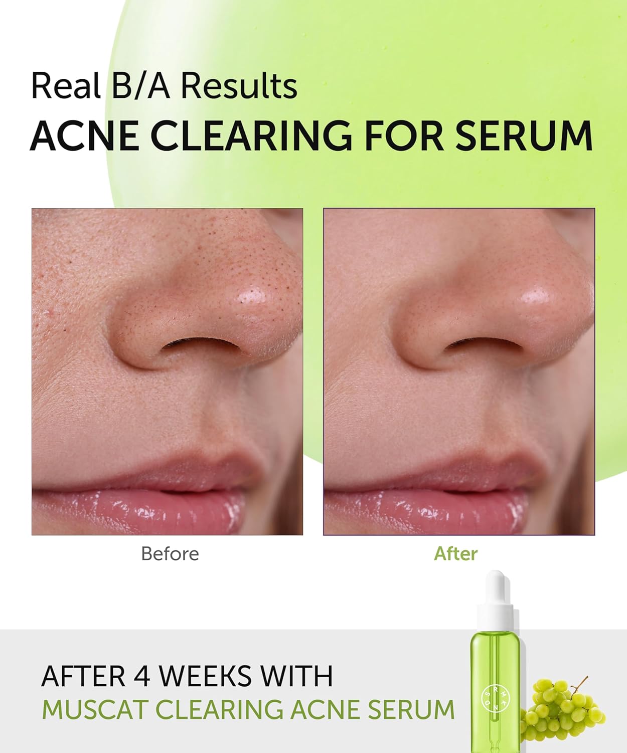 SERUMKIND Muscat Discoloration Correcting facial serum - 1fl oz - Blemishes & blackhead remover - Vegan Not Tested on Animals - Korean Skin Care - PHA Redness Relief and Exfoliating