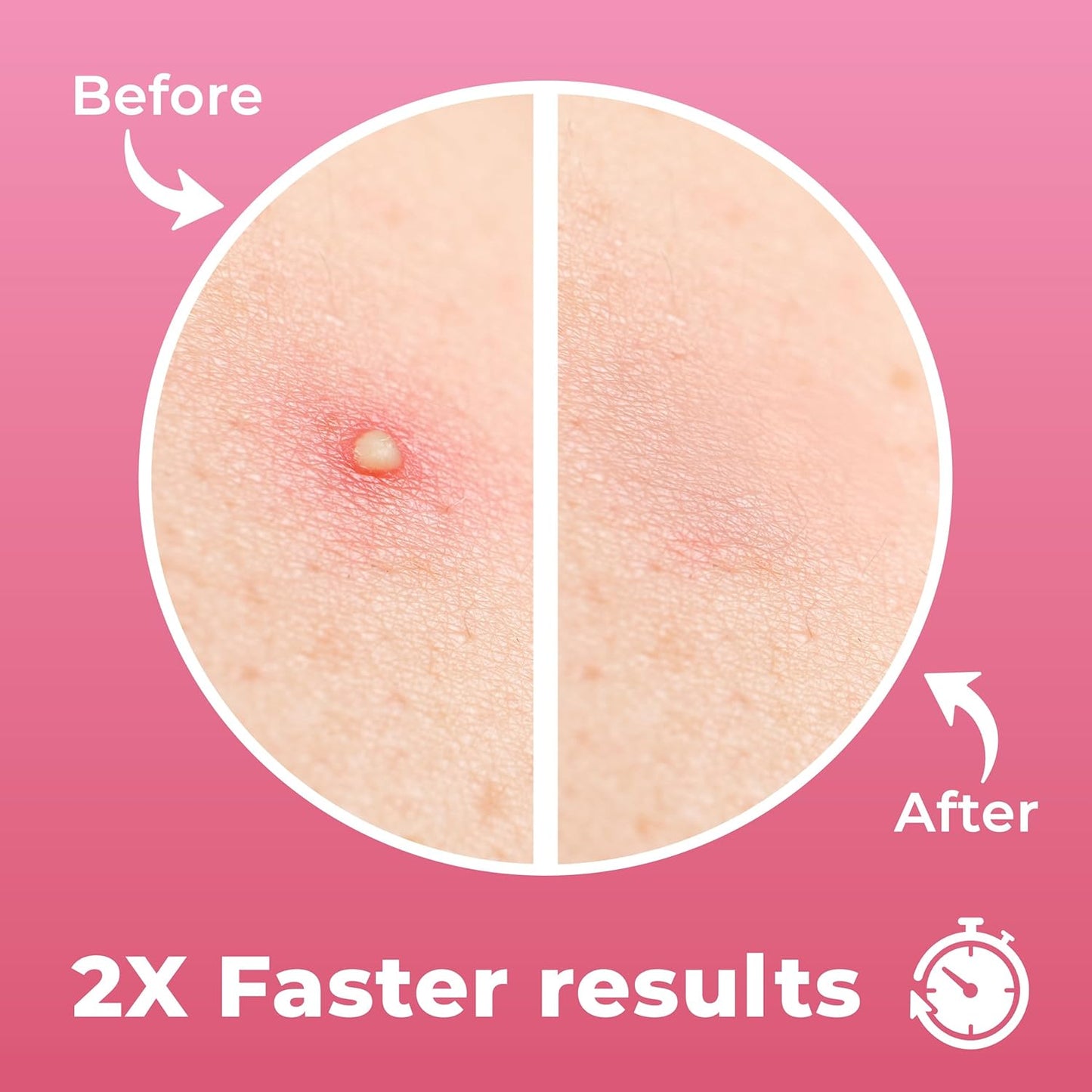 Full Face Pimple Patches (5 Sets), Reduce Pimples On Whole Face Overnight, Hydrocolloid Acne Mask, Pimple Patches, Large Acne Patches, Full Face Hydrocolloid Mask