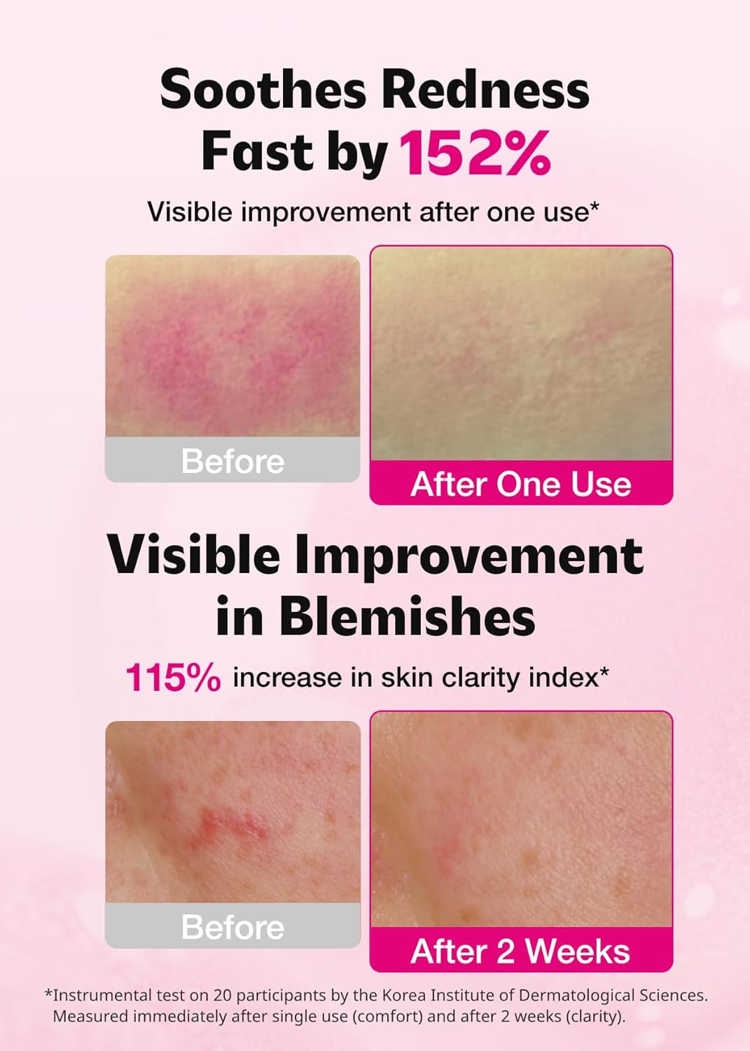 ISOI Blemish Care Up Serum for Face, Vegan Hydrating Serum for Smooth & Glass Skin Effect, Skin Barrier & Moisture Balance for Women, Arbutin, Korean Skin Care (0.85 fl. oz, 25ml)