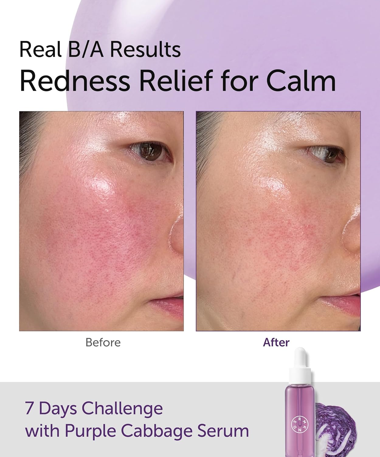 SERUMKIND Purple Cabbage Serum - Calming and Skin Recovery- Korean Face Skincare – Beta Glucan 100,000ppm – Soothing & Redness Relief - Vegan, Cruelty-Free – 1.01 fl.oz.