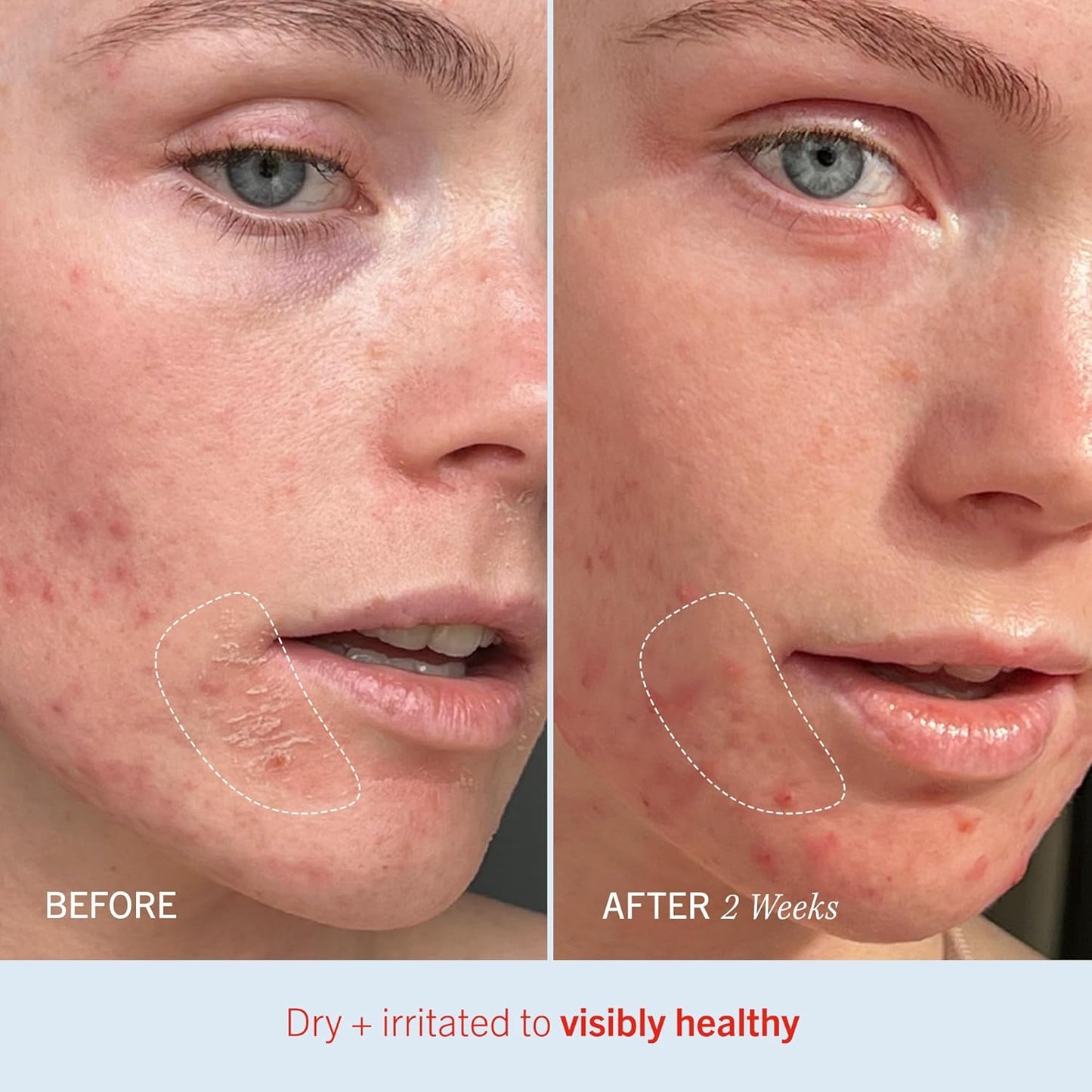 First Aid Beauty - Ultra Repair Cream, Intense Hydration Whipped Colloidal Oatmeal, Clinically Proven to Strengthen Skin Barrier in 7 Days & Helps Relieve Eczema, Luxury Moisturizer, 2 oz, 3 ct