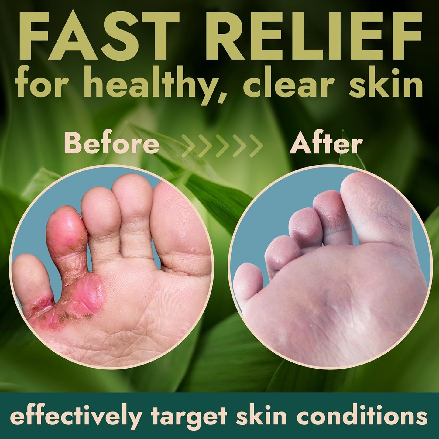 Tea Tree Oil Antifungal Foot Gel | Relieves Jock Itch, Athlete’s Foot & Ringworm | Soothes Itching & Burning | Moisturizes Dry, Cracked Feet | No-Touch Applicator | 1-Week Treatment Option | 20g